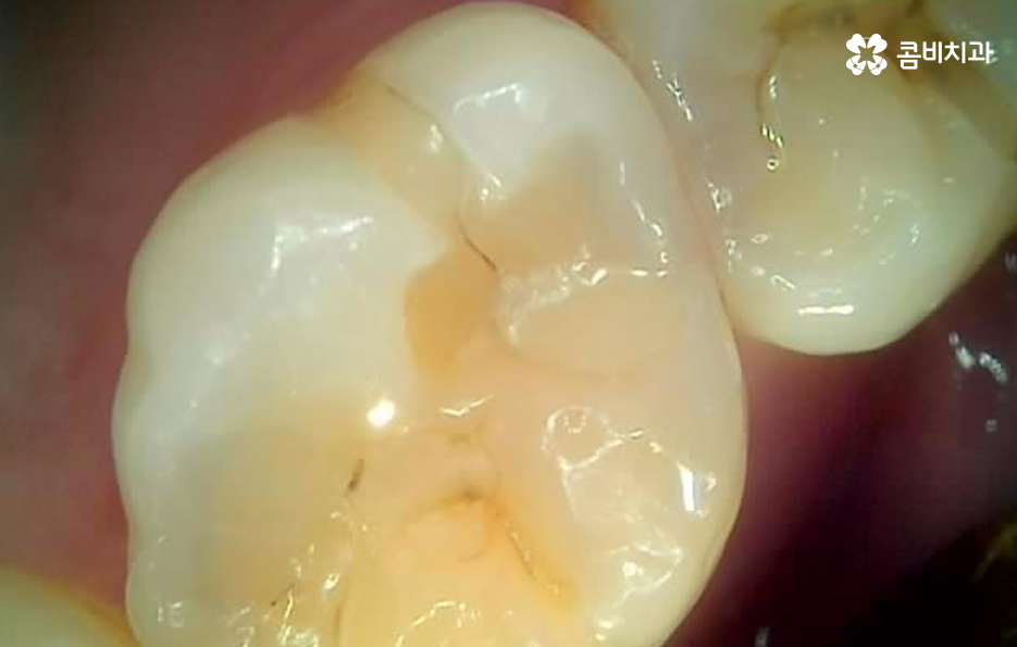 어금니 레진 깨짐 변색 안아파도 이렇게 대처하세요 관련 이미지 8