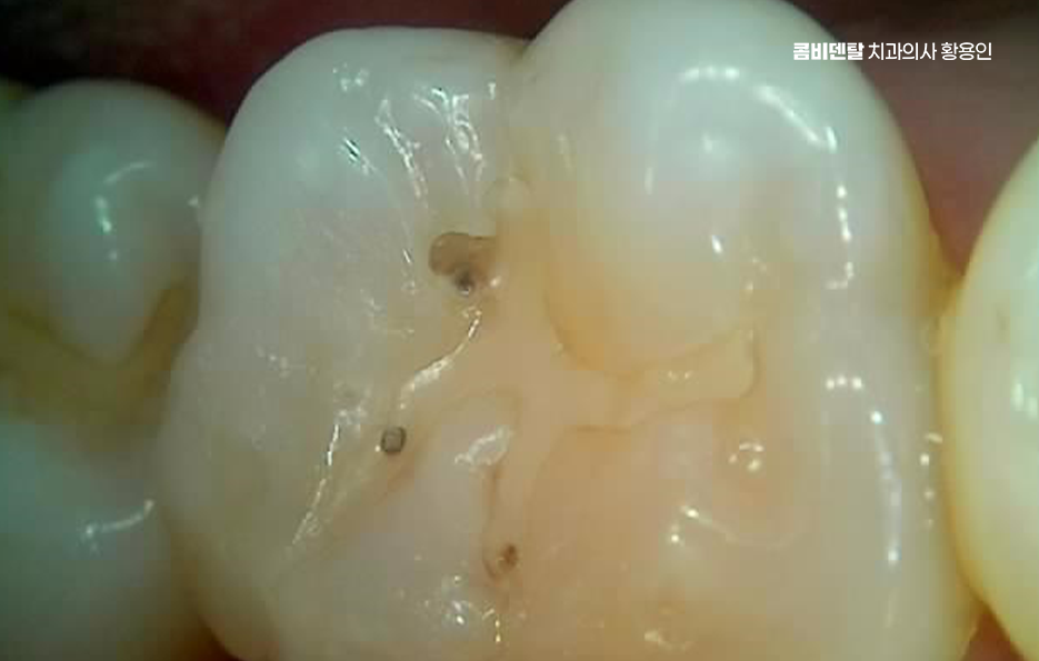 사랑니 주변 잇몸 통증 지금부터가 중요하니까 관련 이미지 2