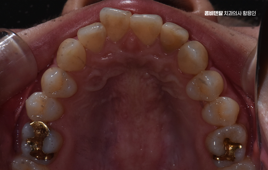 앞니 틀어짐 부분교정 얼마나 걸릴까 관련 이미지 5