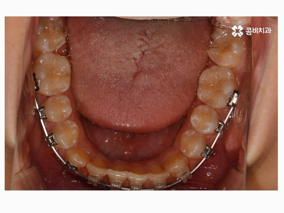 과개교합교정 어릴때 고쳐주면 좋은 사례 관련 이미지 12