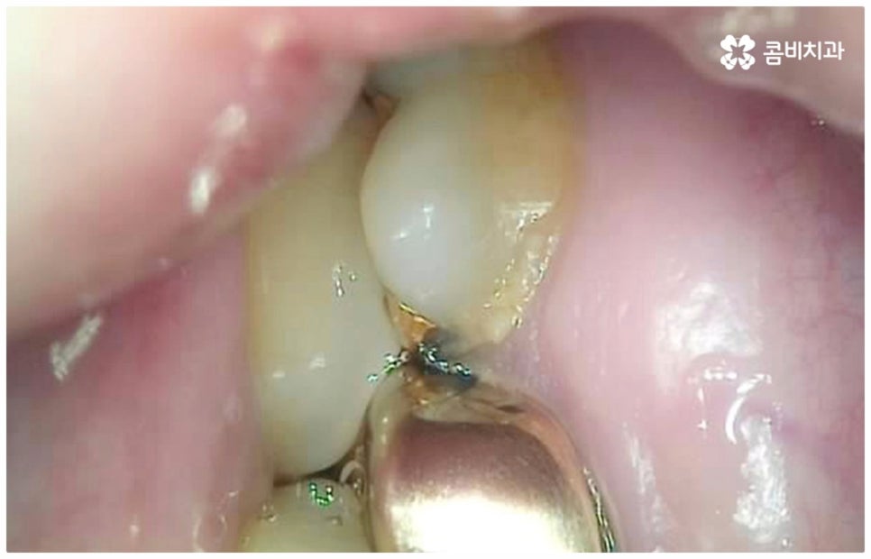 어금니충치치료 아프다면 빨리 관련 이미지 6
