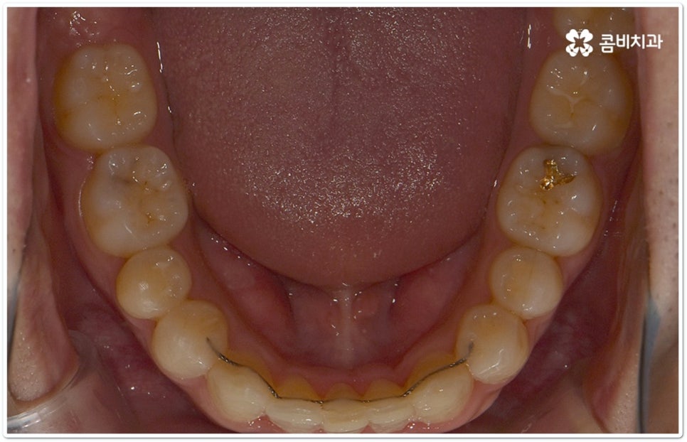 클리피씨교정 합리적인 초이스! 관련 이미지 13