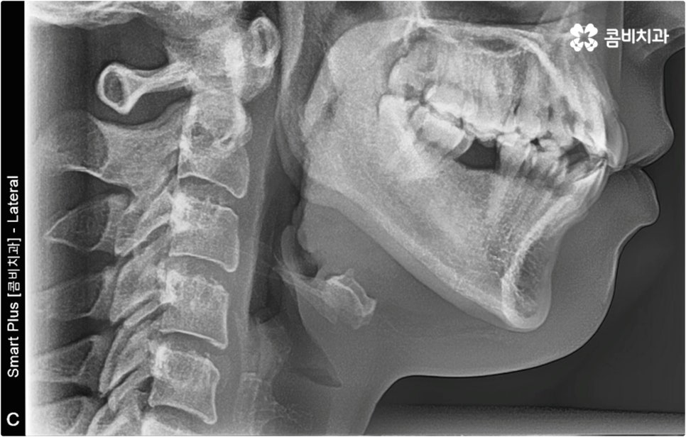 치아설측교정 보이지않아 좋아요 관련 이미지 3