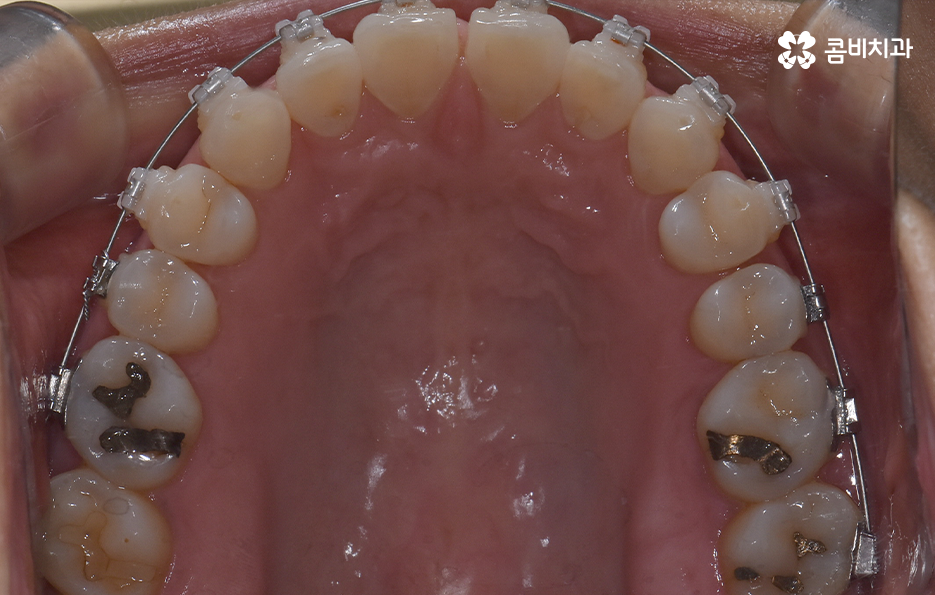 중년치아교정 이제라도 해도 될까요 관련 이미지 14
