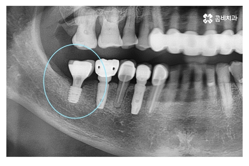 임플란트 기간 케이스에 따라 달라진다면 관련 이미지 7