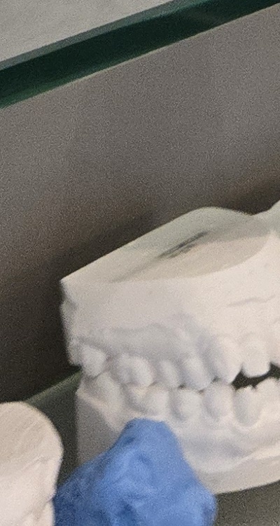 사랑니 주변 잇몸 통증 지금부터가 중요하니까 관련 이미지 47