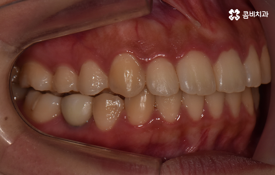 덧니 발치 교정 이런 경우에는 필요합니다 관련 이미지 13