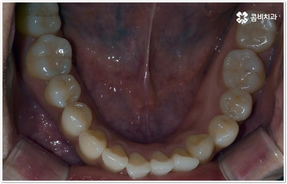덧니부분교정 시작하려면 관련 이미지 8