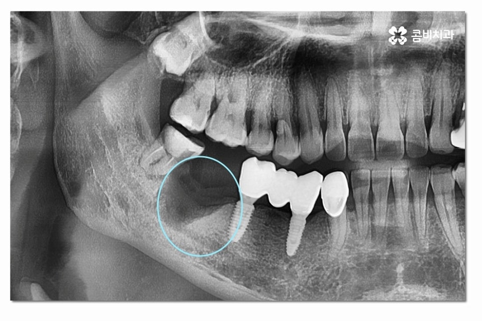 어금니임플란트 합리적으로 알아보려면 관련 이미지 4