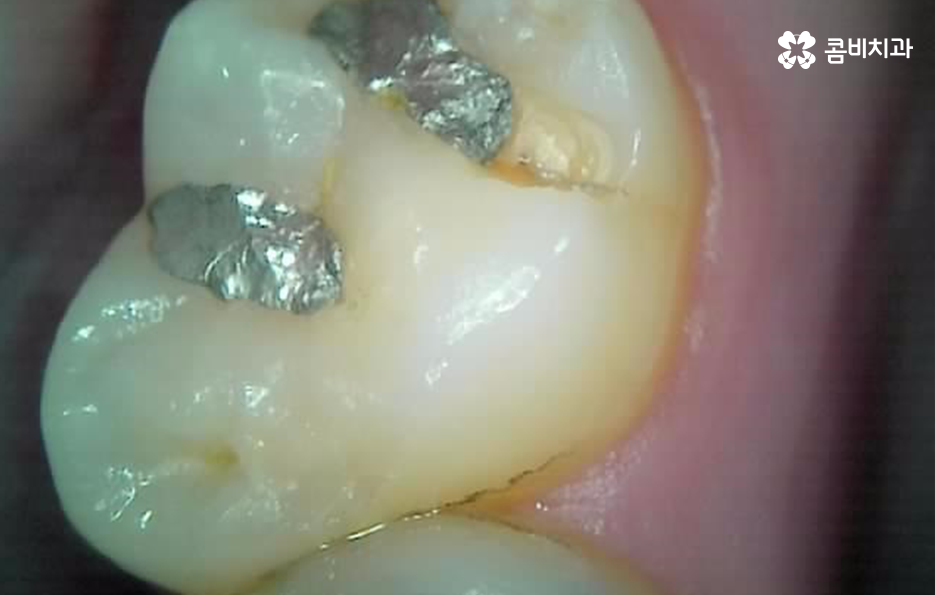어금니 충치 깨짐 판단기준부터 세워보세요 관련 이미지 5