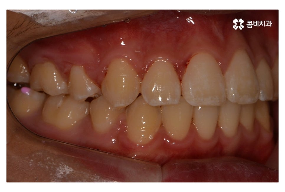 중학생치아교정 세심하게 체크하려면 관련 이미지 15