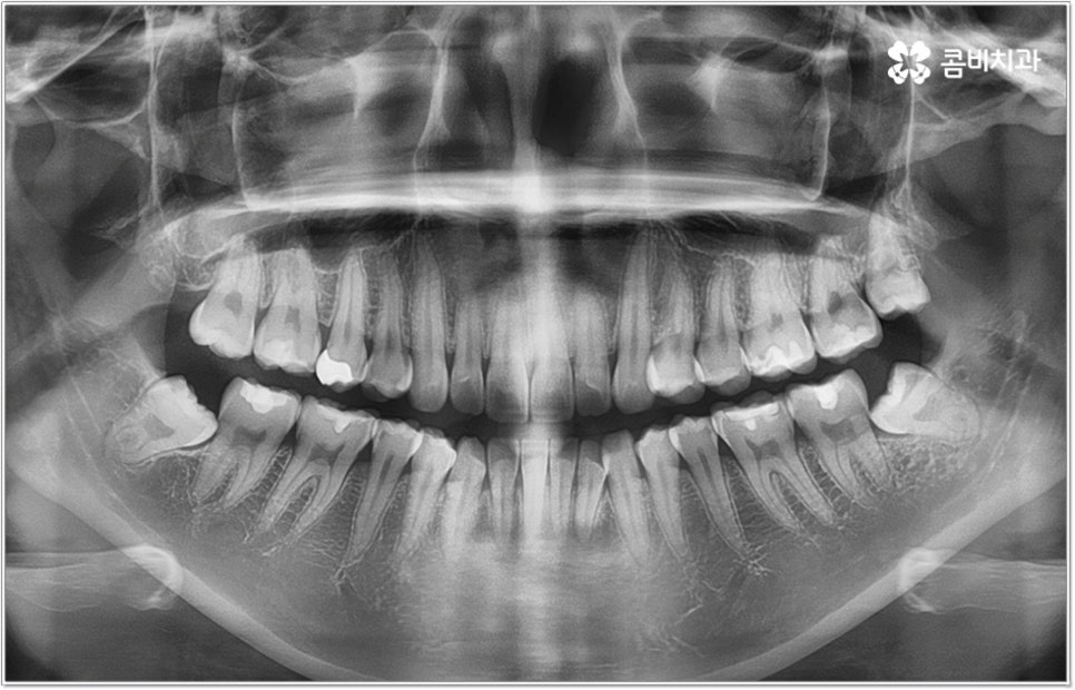 비발치치아교정 언제 할수있나요 관련 이미지 2