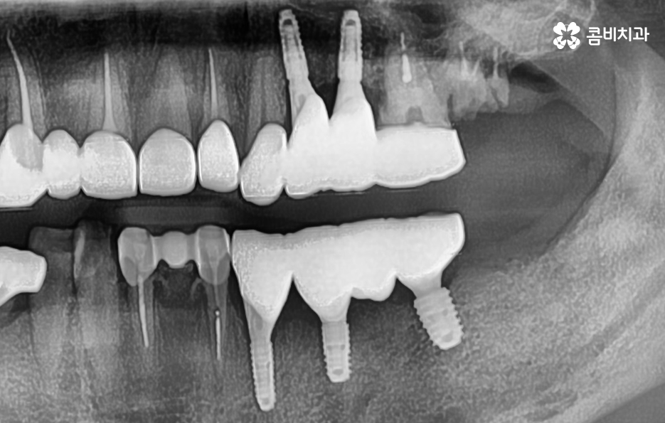 임플란트 치조골 상태에 따라 치료 계획도 달라지나요 관련 이미지 9
