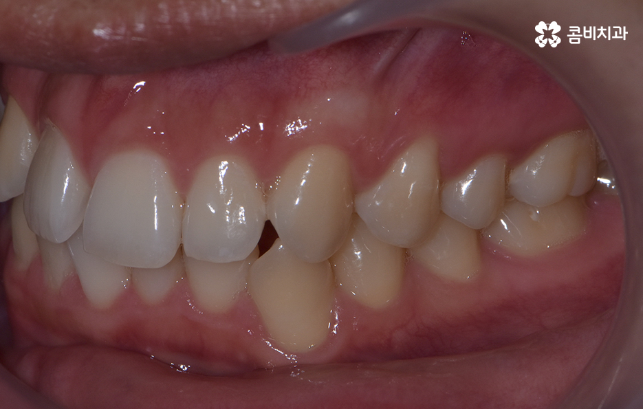 덧니 발치교정으로 교정할 때 치아가 이렇게 이동해요 관련 이미지 4