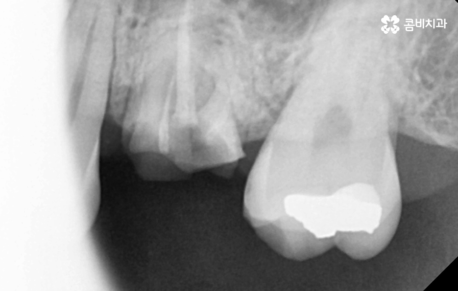 충치 신경치료 안하면 후회하는 이유 관련 이미지 9