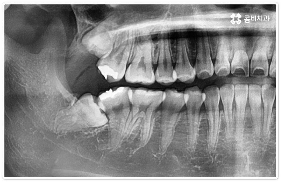 누운사랑니발치 이모저모 알아봐요 관련 이미지 9