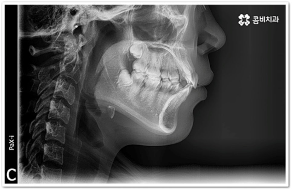 덧니 발치 언제 하나요? 관련 이미지 1