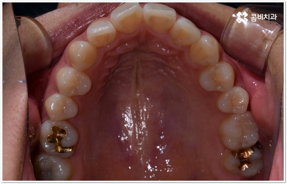 덧니부분교정 시작하려면 관련 이미지 7