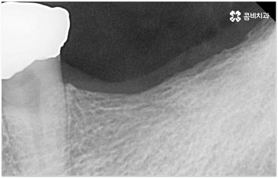 뼈이식임플란트 언제하나요? 관련 이미지 11