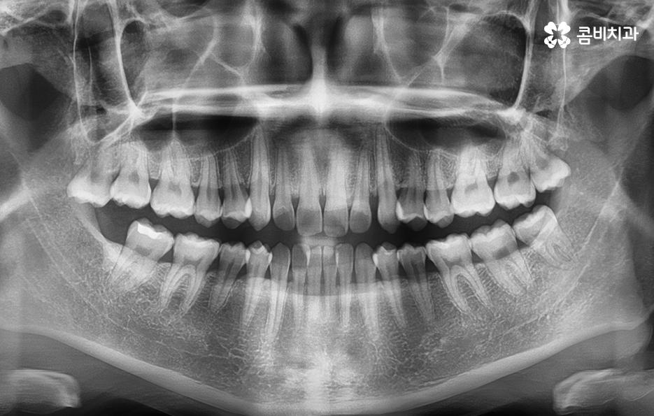 비발치치아교정 고민되는데 발치하면 안좋나요 관련 이미지 2