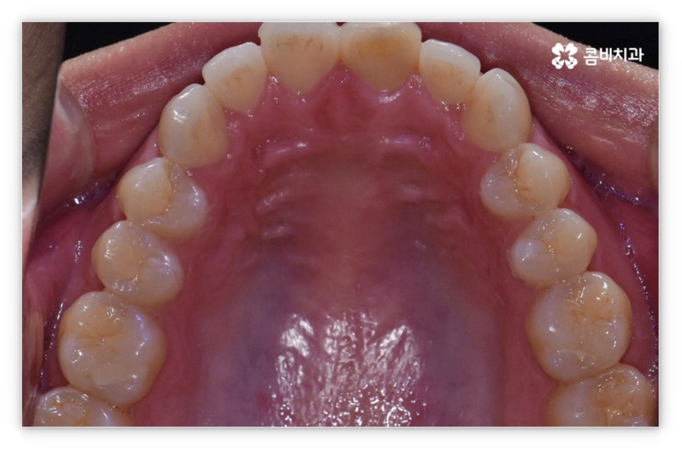 앞니설측교정 망설여질때는 관련 이미지 4