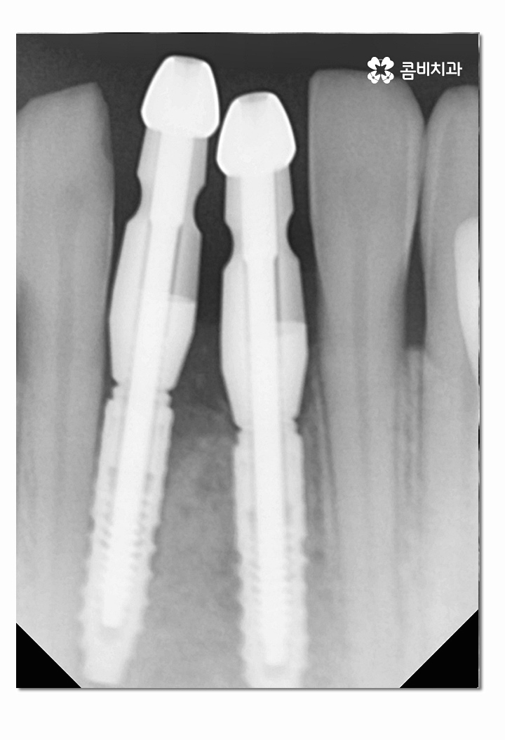 치주염으로 인한 아랫니 임플란트 절차를 알아보면 관련 이미지 9