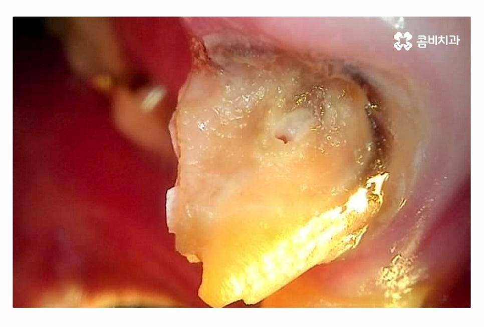 20대임플란트 갈수록 늘어나는 이유는 관련 이미지 3
