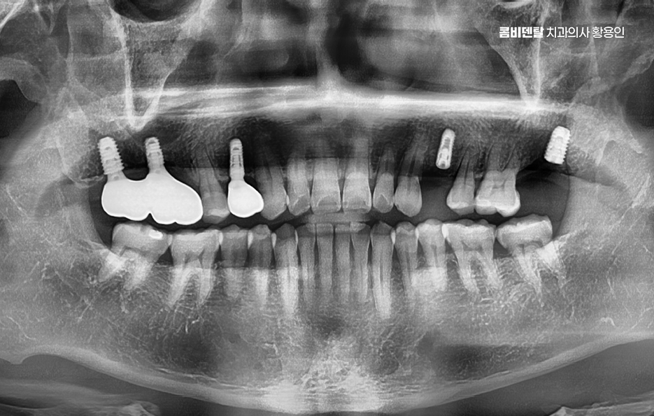 어금니 없으면 얼굴 발음에 어느정도나 안좋을까 관련 이미지 13