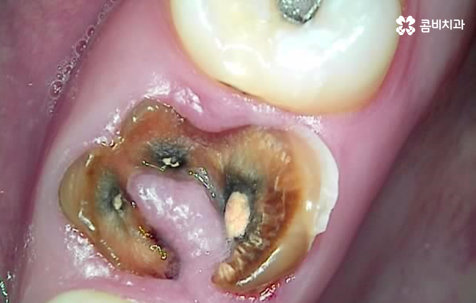 충치 신경치료 안하면 후회하는 이유 관련 이미지 5
