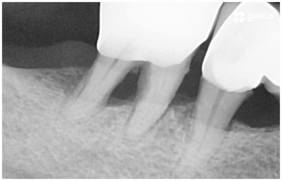 임플란트수명 연장하려면? 관련 이미지 4