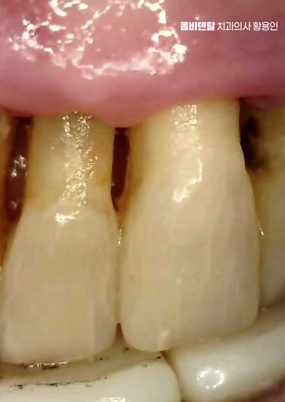치아 사이 벌어짐 심해지는 이유부터 알아보면 관련 이미지 7