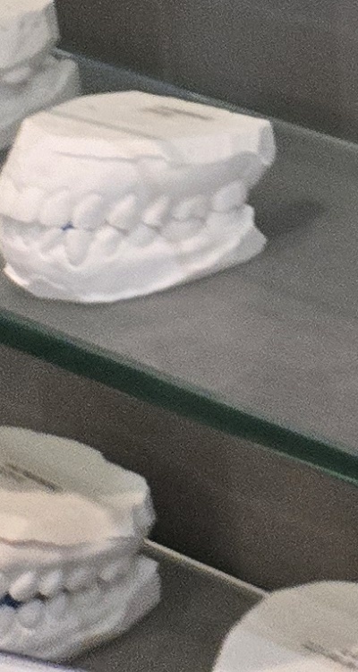 윗니 전체 임플란트 뭐부터 해야할까 관련 이미지 41