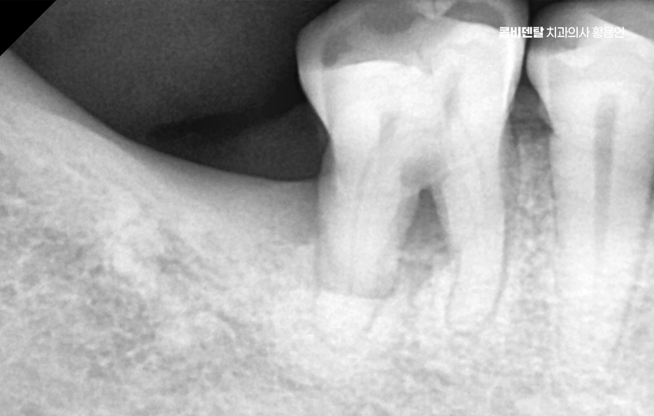 어금니 임플란트 과정 제대로 이해하려면 관련 이미지 3