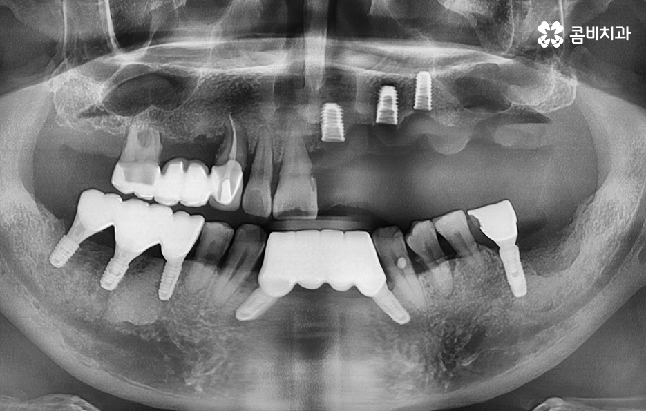 노인임플란트 이것만큼은 기억하세요 관련 이미지 11