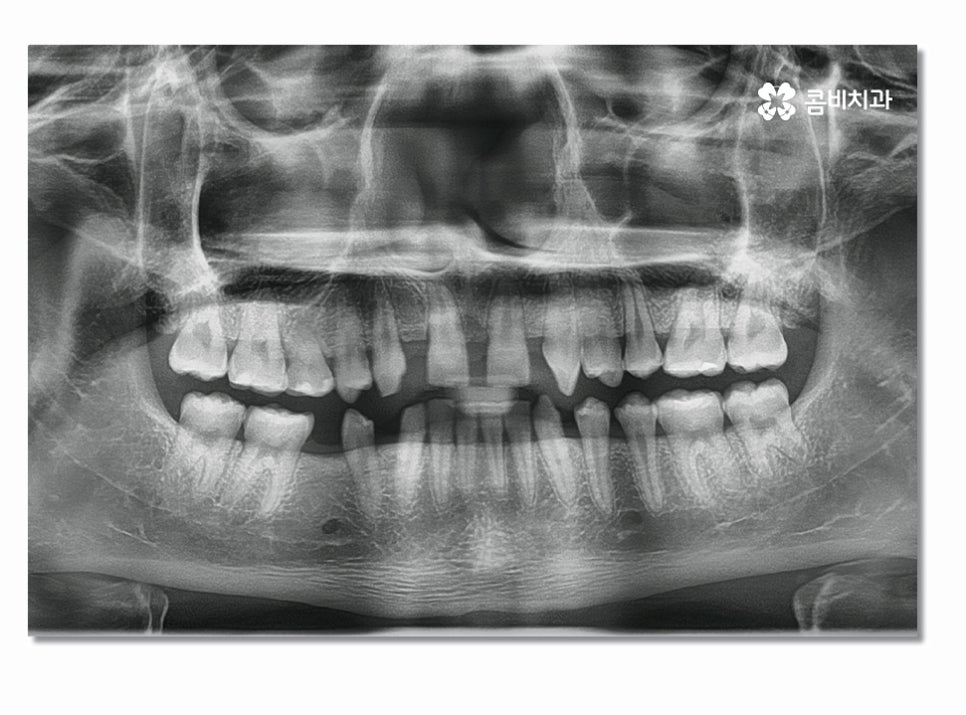 앞니임플란트 합리적으로 접근하려면 관련 이미지 1