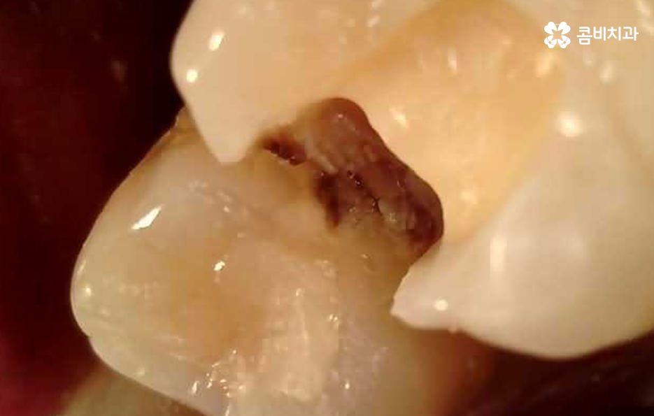 레진 인레이 치료 후 2차충치 왜 발생하고 어떻게 대처할까 관련 이미지 9