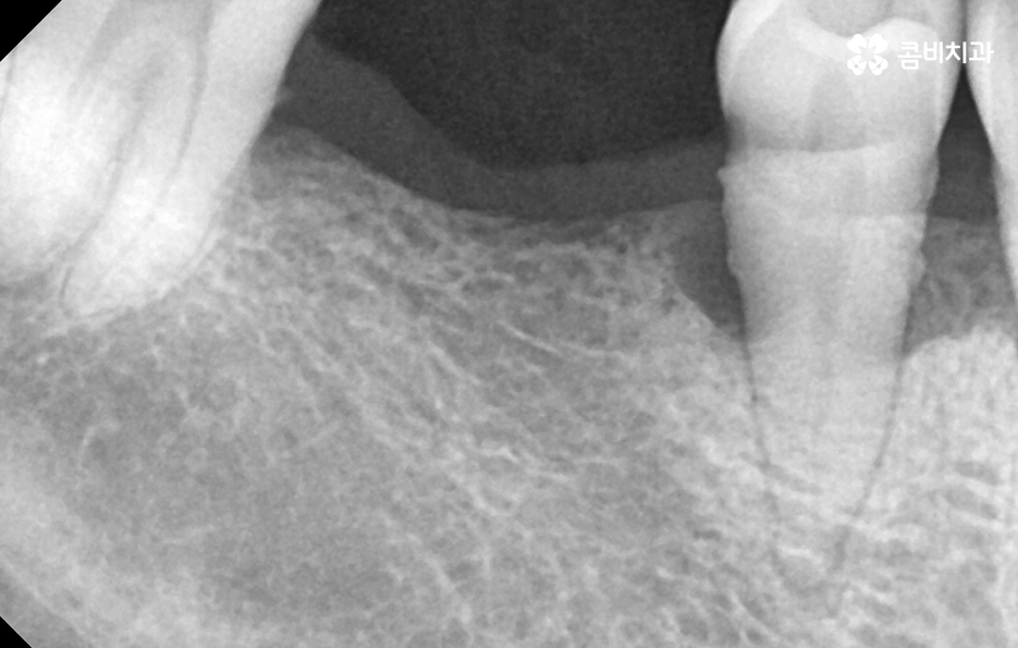 노인임플란트 이때부터 특히 조심하세요 관련 이미지 7