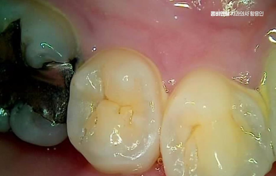 아말감 교체 레진 인레이 어떻게 대처하면 될까 관련 이미지 5