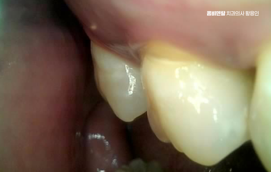충치 검은점 나타났다면 이렇게 대처해요 관련 이미지 5
