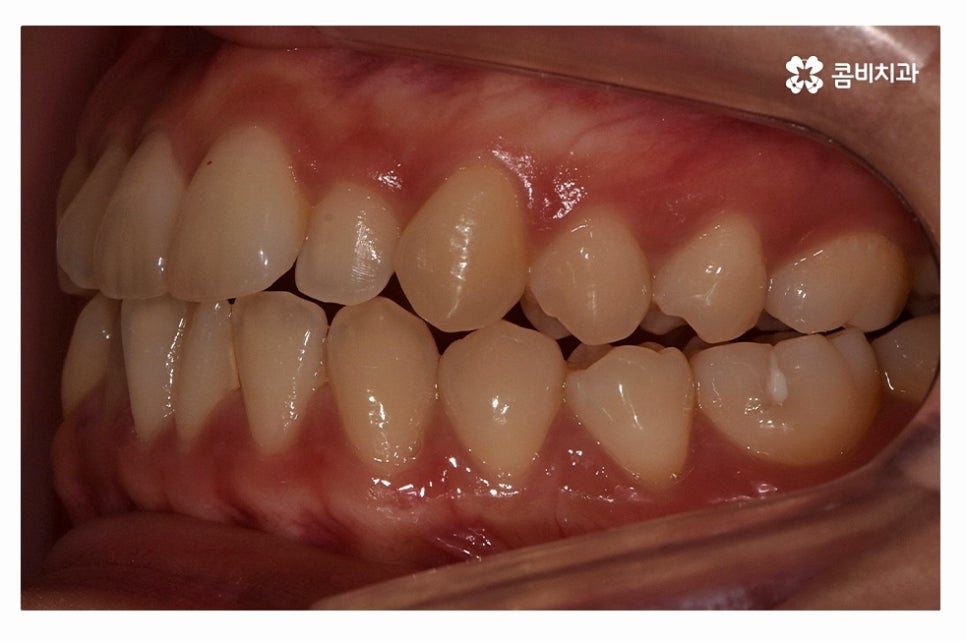 덧니교정 체계적으로 준비하려면 관련 이미지 2