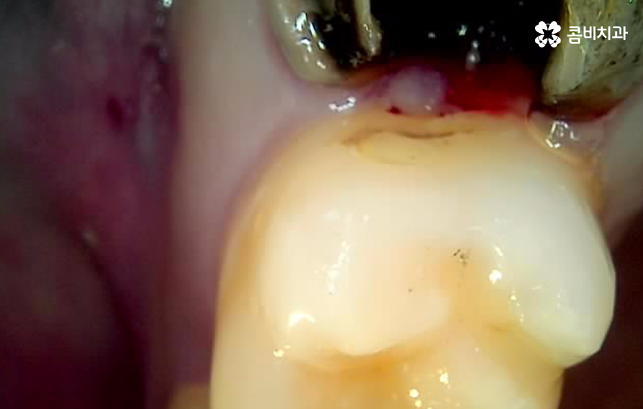어금니 발치후 임플란트 이런점을 주의합시다 관련 이미지 4