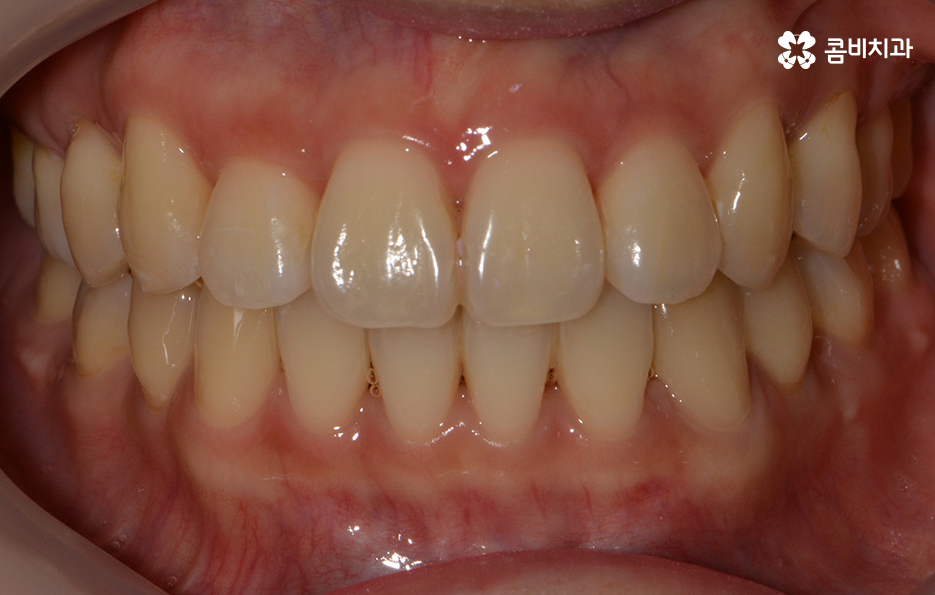 앞니치아교정 자연스러운 결과를 위해 알아둬야 할 점 관련 이미지 10
