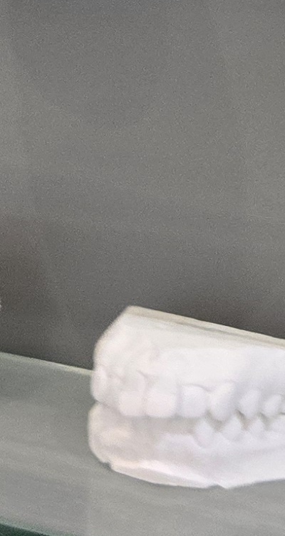 윗니 전체 임플란트 뭐부터 해야할까 관련 이미지 34