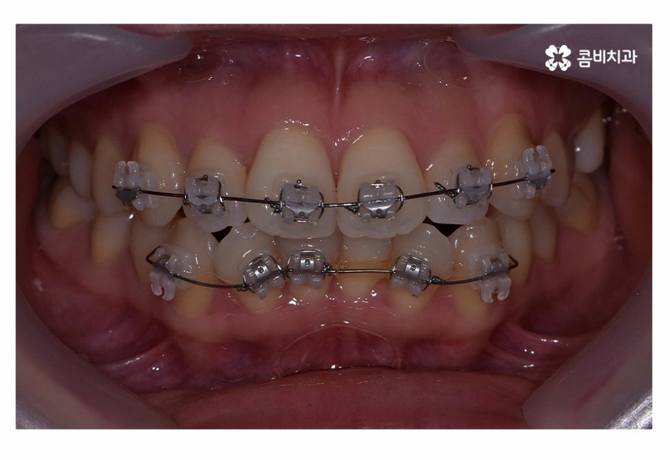 치아부분교정 나도 해당될지 궁금하다면 관련 이미지 5