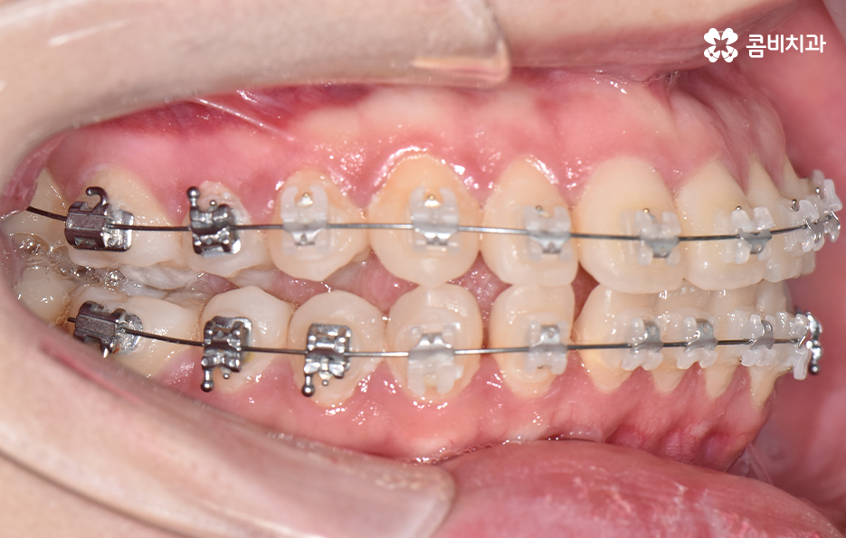 아래앞니 벌어짐 교정으로 해결했어요 관련 이미지 8