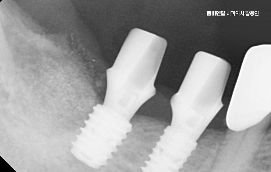 어금니 임플란트 뼈이식 이럴때 해당됩니다 관련 이미지 10