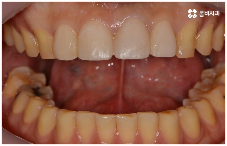 앞니충치치료 어떻게 이뤄지나요 관련 이미지 7