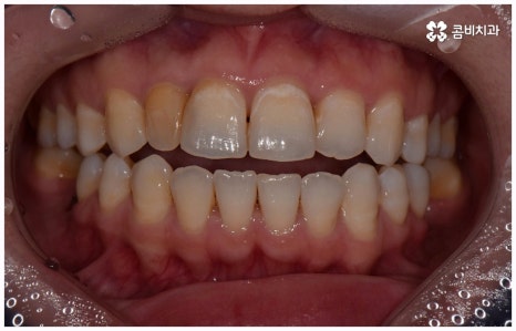 임플란트 종류 어떤게 맞을까요? 관련 이미지 10