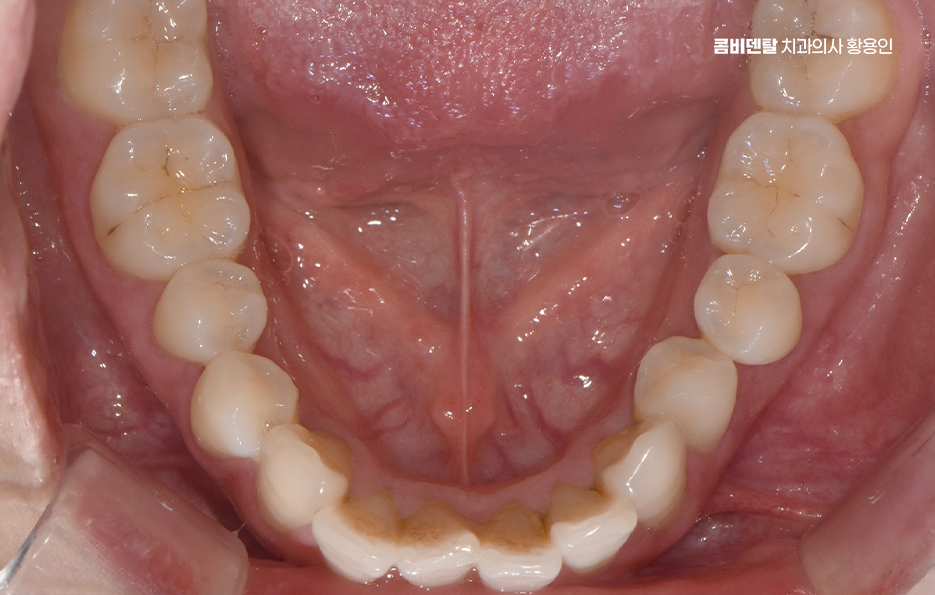 돌출입 팔자주름 교정 얼마나 바뀔까요 관련 이미지 5