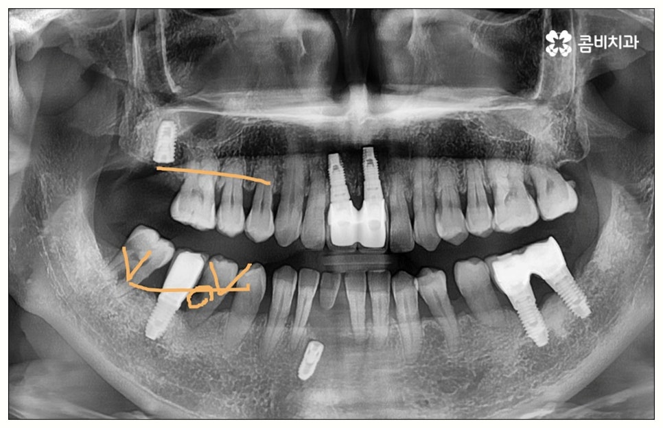 원데이임플란트 어떤가요? 관련 이미지 3